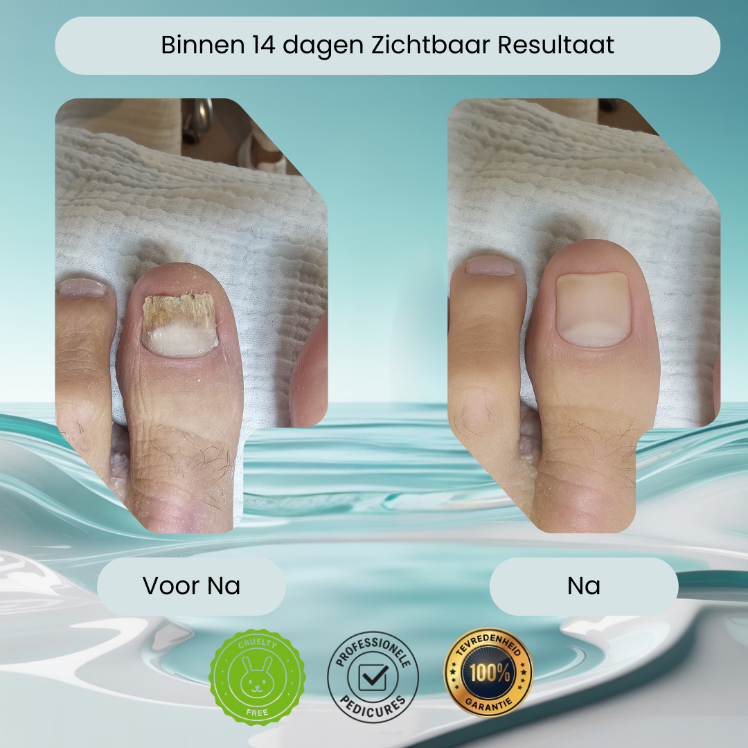 BAIS Kalknagel Tinctuur 30ml | Bewezen Middel Tegen Schimmelnagels | Bezorgd 1-2 Dagen